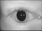Nystagmus spontane vestibulaire.avi