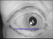 nystagmus torsionnel titre bleu.wmv