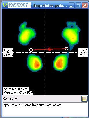 Contrôle des appuis plantaires Contrôle des appuis plantaires