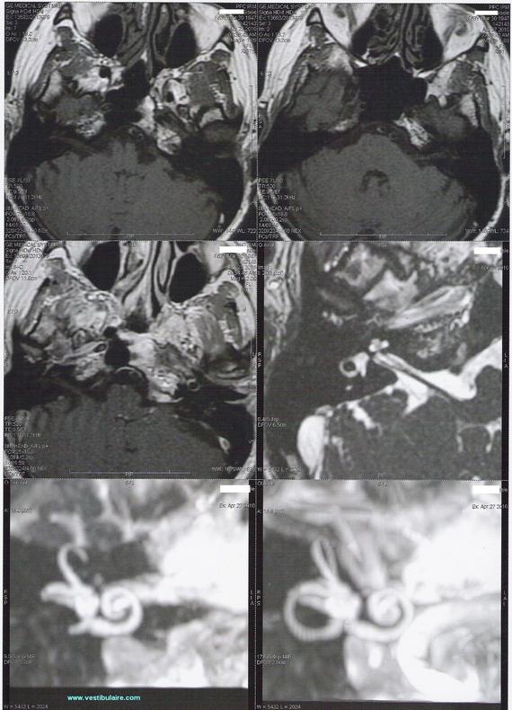 Cupule et Cellules ciliées vestibulaires Cupule et Cellules ciliées vestibulaires