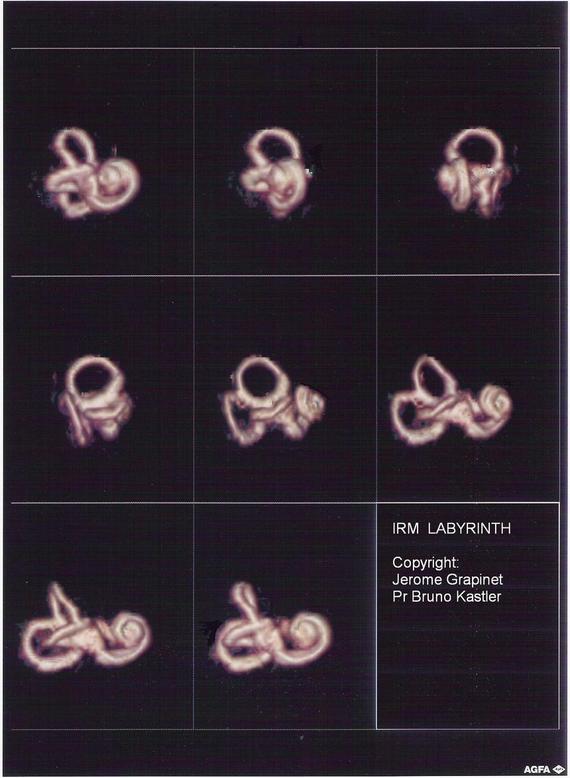 IRM 3tesla du labyrinthe IRM 3tesla du labyrinthe