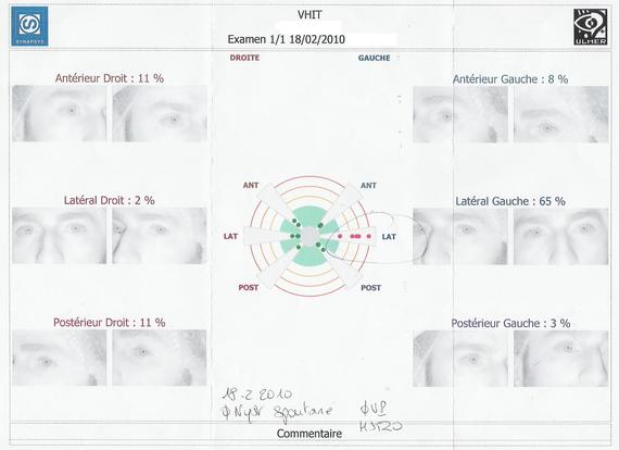Hypo-fonction du canal latéral gauche Hypo-fonction du canal latéral gauche