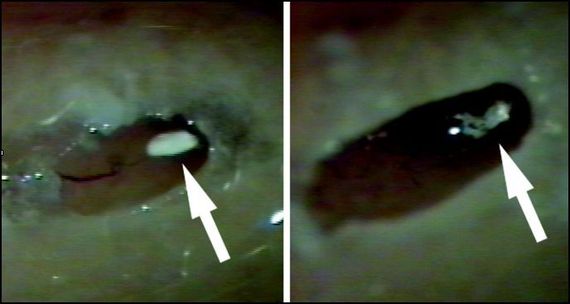 Otolithes flottant dans le canal semi-circulaire. Parnes et McClure