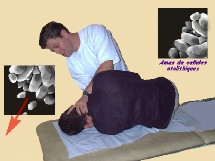 La manoeuvre libératoire dans le VPPB (Semont liberatory maneuver for posterior BPPV)- Rééducation vestibulaire La manoeuvre libératoire dans le VPPB (Semont liberatory maneuver for posterior BPPV)- Rééducation vestibulaire